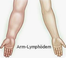 Forschung: Anonyme Umfrage zu Arm-Lymphödem – bitte mitmachen!